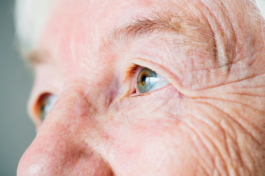 Collagen peptides benefits: a senile woman.