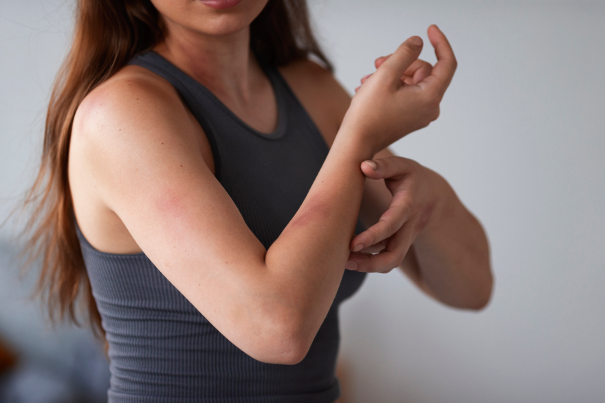 Mounjaro injection sites: a woman with a rash on her arm.